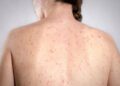Morbillo, l’allarme dell’infettivologo Andreoni: “Casi in crescita, ricoveri frequenti negli adulti”