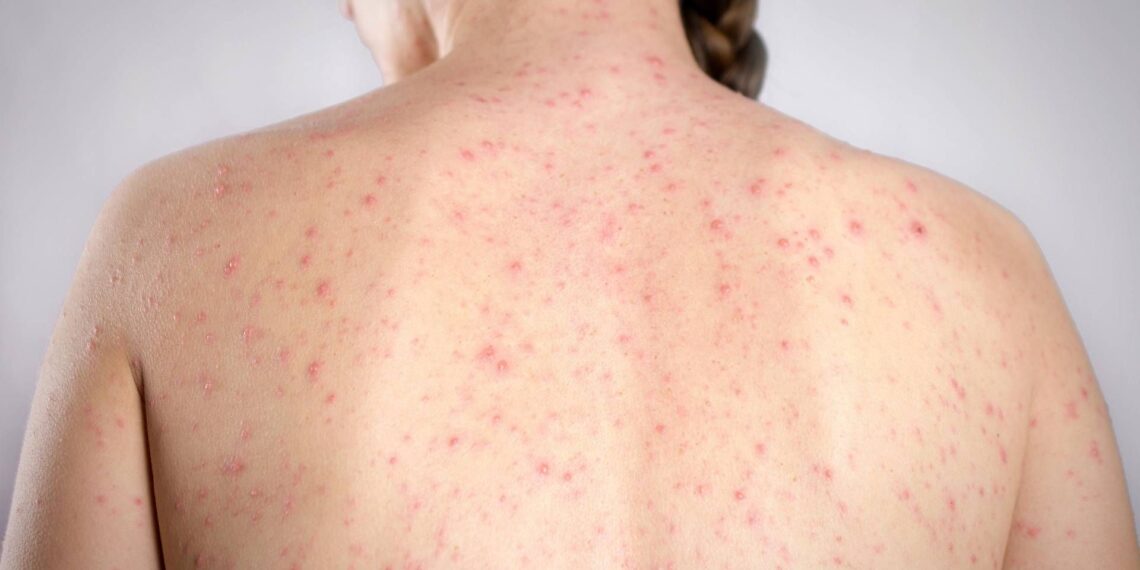 Morbillo, è allarme negli Usa. Italia prima per casi in Europa in in primi 6 mesi 2026