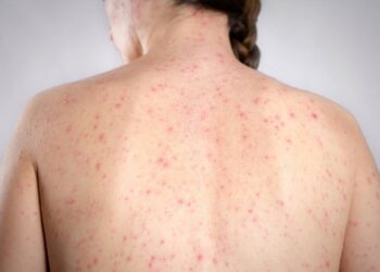 Morbillo, è allarme negli Usa. Italia prima per casi in Europa in in primi 6 mesi 2026